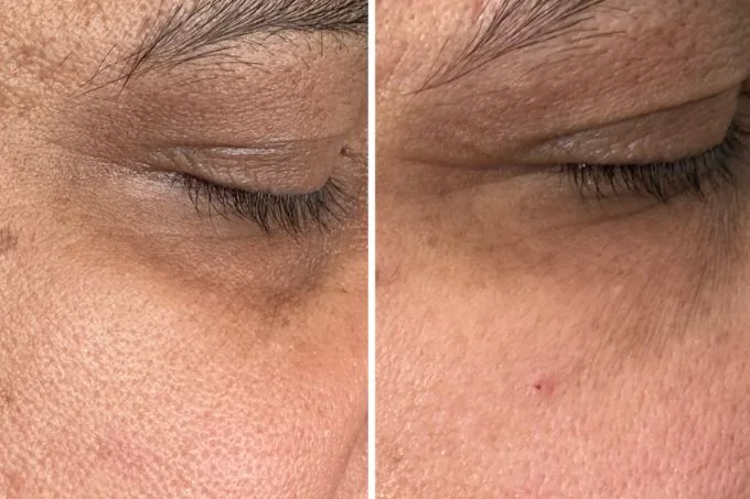 Under Eye Result